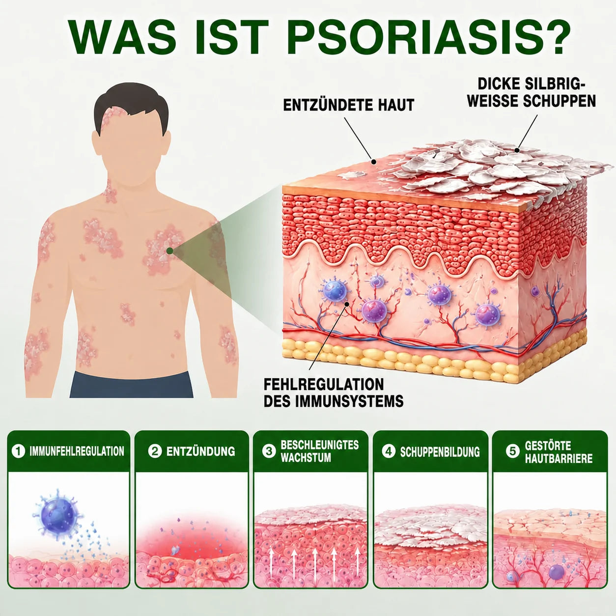 AQA DE Bild 04 – Psoriasis erklärt