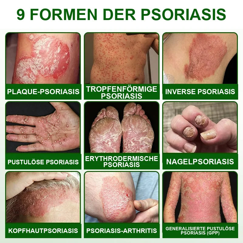 AQA DE Bild 05 – Formen der Psoriasis