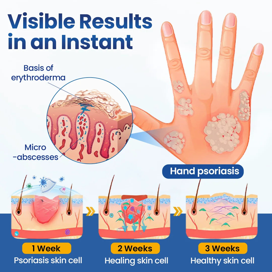 AQA® PsoriaMucin No-Rub Itch & Flake Relief Mist
