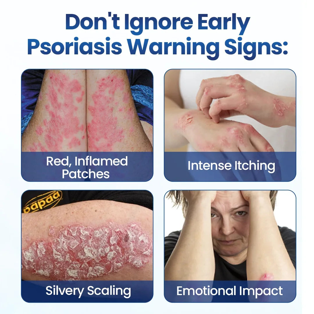 AQA® PsoriaMucin No-Rub Itch & Flake Relief Mist