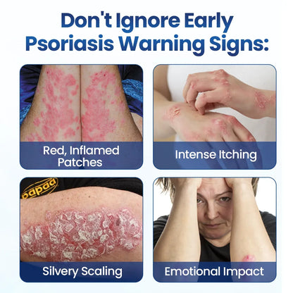 AQA® PsoriaMucin No-Rub Itch & Flake Relief Mist