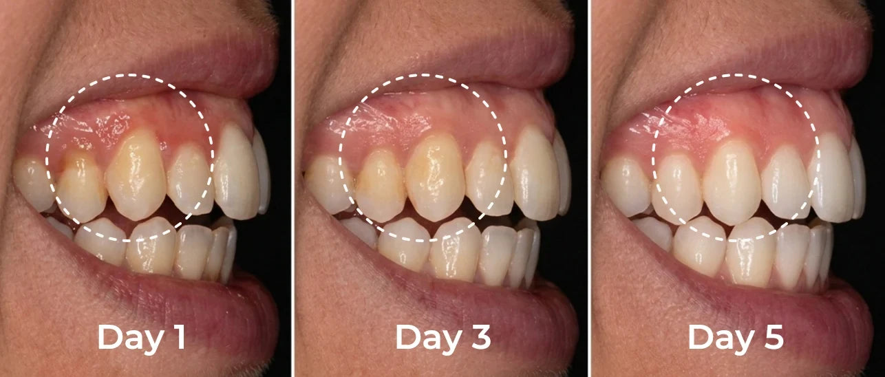 Reference visual showing a five-day gum-care sequence